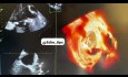 Left Atrial Appendage - Echocardiography