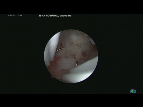 Hysteroscopic Cold Knife Evacuation of Products of Abortion in Case of Incomplete Abortion