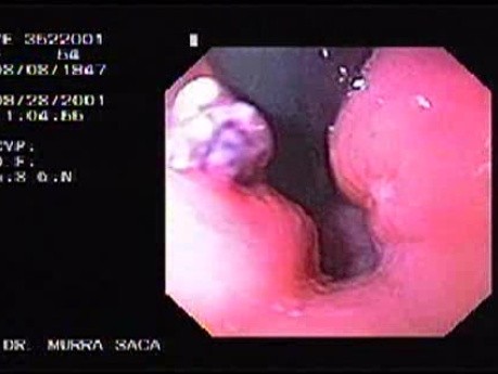 Mallory-Weiss Tear - Ulceration with the Blood Clot, Part 2