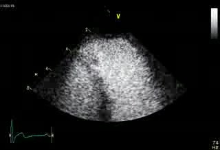 Arrhythmogenic Right Ventricular Cardiomyopathy