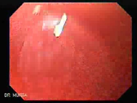 Flat Adenoma - Endoscopy (1 of 2)