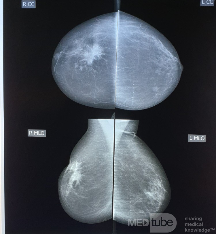 Mammography 