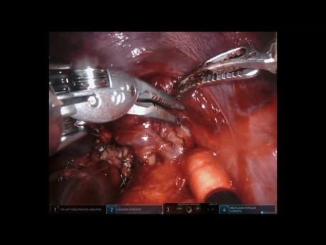 Right Upper Lobectomy (Robotic)