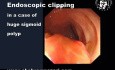 Prophylactic Clips to Reduce Delayed Polypectomy Bleeding After Resection of Large Colorectal Polyp