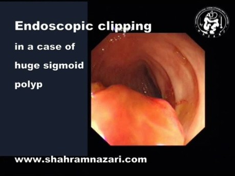 Prophylactic Clips to Reduce Delayed Polypectomy Bleeding After Resection of Large Colorectal Polyp