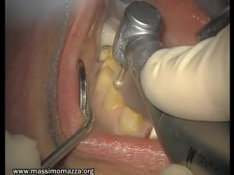 Upper Arch Teeth Preparation And Provisional Crowns (3/5)