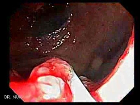 Giant Tubulo - Villous Adenoma (13 of 17)