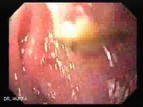 Esophagel Varices and Status Post Total Gastrectomy - Endoscopic Image