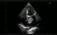 Left atrial tumor (1/2)