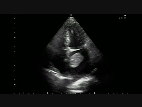 Left atrial tumor (1/2)