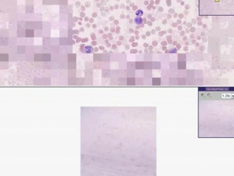 Chronic myelogenous leukemia - Histopathology - Blood