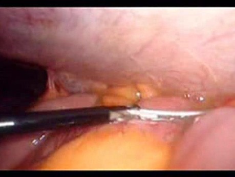 Colonic Perforation With Peritonitis - Laparoscopy (34 of 46)