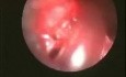 Dumon Stent In Trachea - Postintubation Stenosis