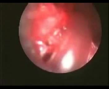 Dumon Stent In Trachea - Postintubation Stenosis