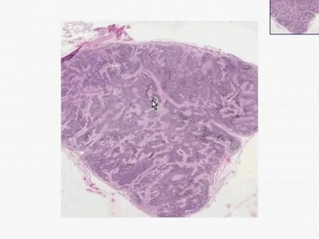 Anthracosis