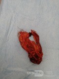 Ischemic Colitis