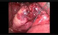 Minilaparoscopic Surgery The 2nd reduced Port Surgery Forum