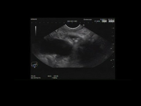 Common Bile Duct Stone With Biliary Plastic Stent