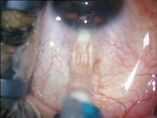 ICL Implantation In High Myopic Case With Thin Cornea