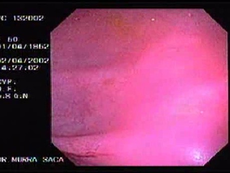 Metastasis Of Renal Carcinoma To The Ascending Colon (4 of 11)