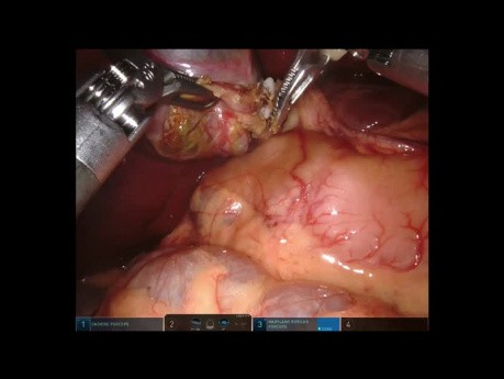 Pediatric Robot-assisted Cholecystectomy