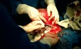Giant Male breast malignant tumor - 15kg