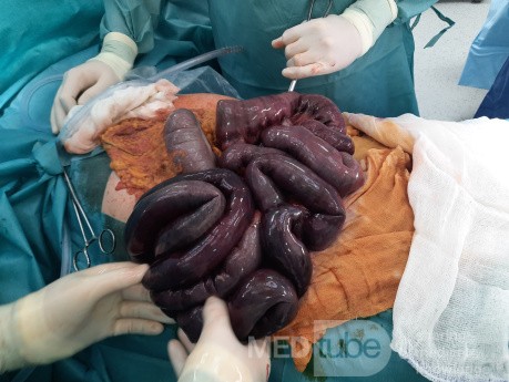 Vascular Ileus