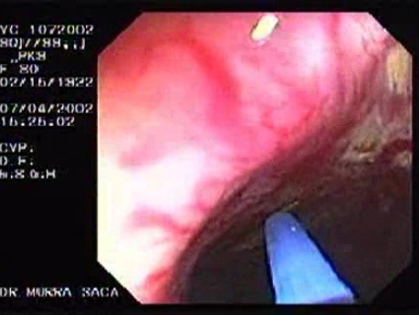 Post-Radiation Colitis (3 of 4)