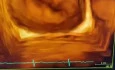 Cleft Anterior Leaflet of MV