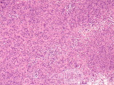 Gastrointestinal Stromal tumor (GIST) (57 of 65)