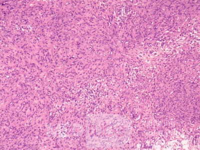 Gastrointestinal Stromal tumor (GIST) (57 of 65)