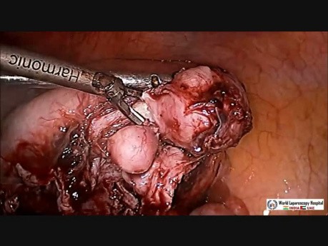 Laparoscopic Myomectomy and Ovarian Cystectomy for Multiple Myomas and Paraovarian Cyst