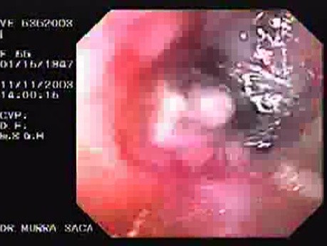 Endoscopic Variceal Ligation - Status Post Therapy