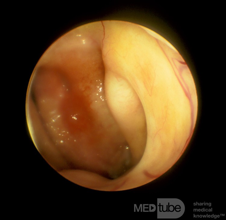 Eustachian Tube Orifice [left]
