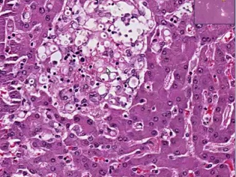 Cryptococcosis