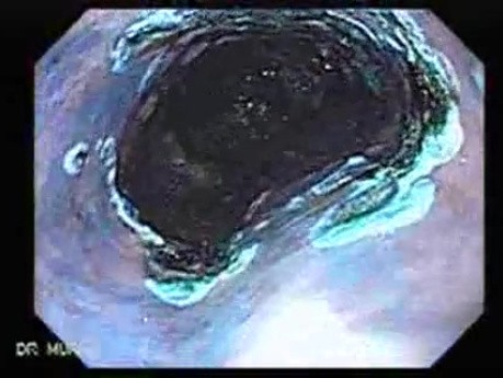 Barrett's Esophagus of long segment (12 of 24)