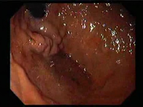 Gastric Varices - Endoscopic Ablation With Cyanoacrylate Glue (4 of 18)
