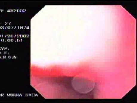 Endoscope Insertion