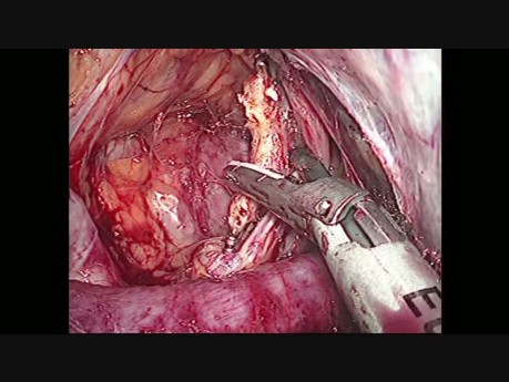 Laparoscopic Right Adrenalectomy