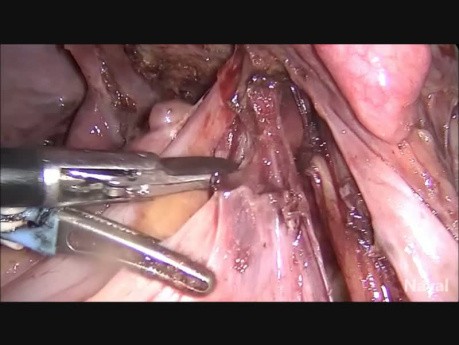 TLH BSO for Stage 4 Endometriosis Frozen Pelvis with Deep Endometriosis Excision
