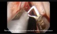 Microflap Technique (MLE) - Angiomatous Polyp of Left Vocal Cord