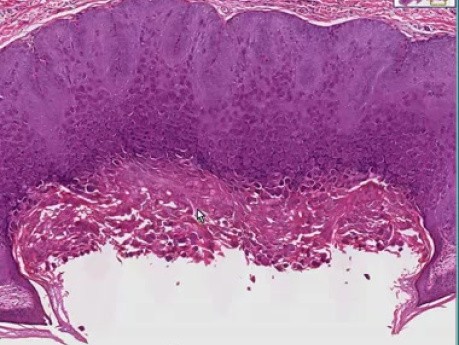 Molluscum contagiosum