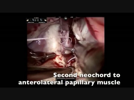 Robotic mitral valve repair of anterior leaflet perforation and ruptured chordae with EndoDirect cannulation