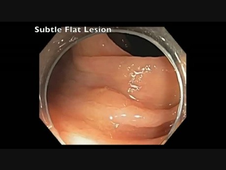 Subtle Flat Lesion EMR