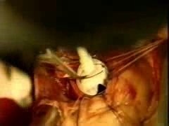 Valve Replacement Surgery