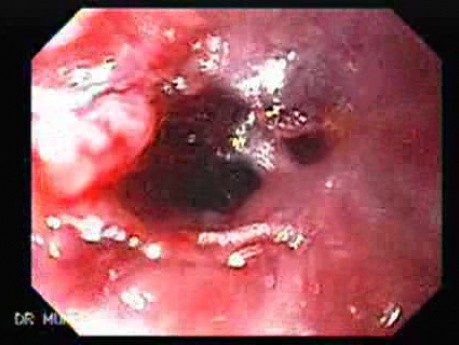 Perforation of a Esophageal Carcinoma After the Procedure with Hydrostatic Balloon Dilation - View from Upper Esophageal Sphincter