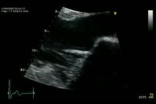 Mitral Valve Regurgitation
