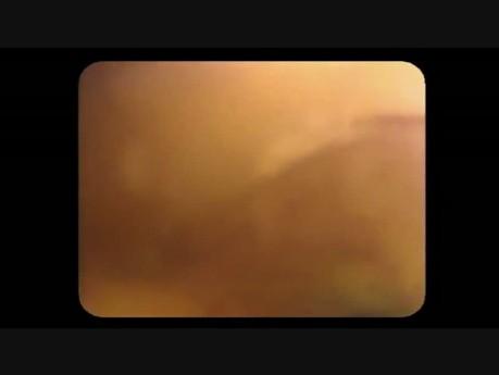 Colonoscopy Channel Quiz 15