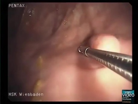 Intussusception of the Appendix