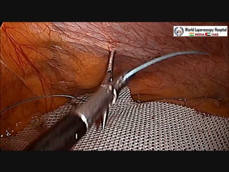 Para-Umbilical Hernia IPOM Repair
